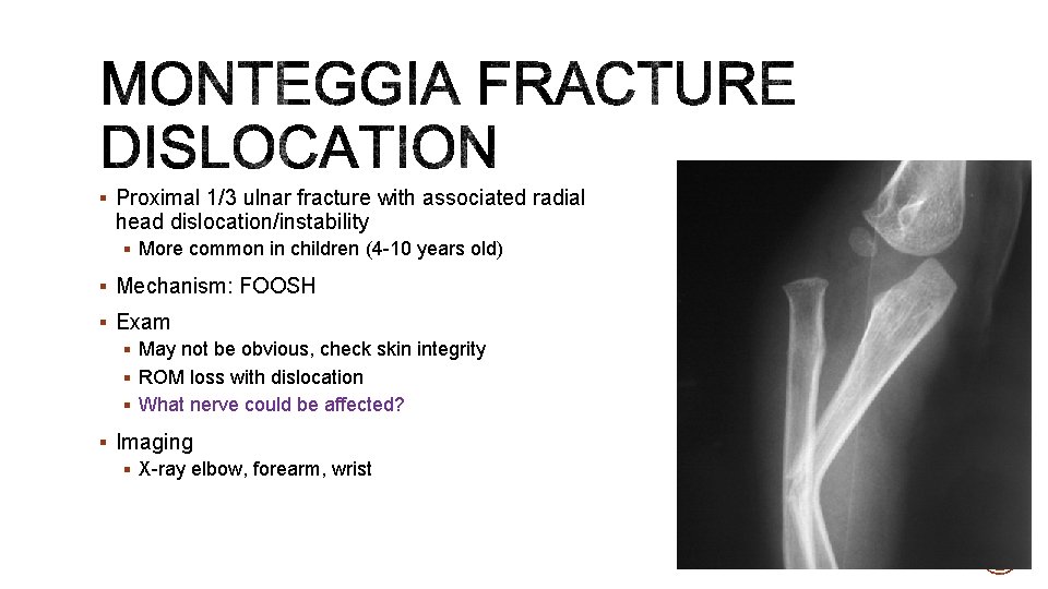 § Proximal 1/3 ulnar fracture with associated radial head dislocation/instability § More common in