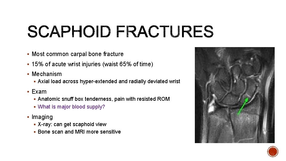 § Most common carpal bone fracture § 15% of acute wrist injuries (waist 65%