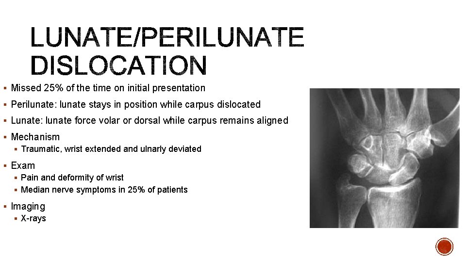 § Missed 25% of the time on initial presentation § Perilunate: lunate stays in