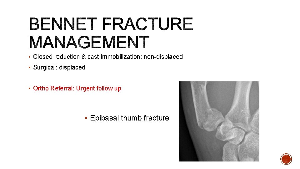 § Closed reduction & cast immobilization: non-displaced § Surgical: displaced § Ortho Referral: Urgent