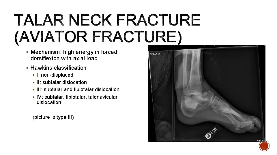 § Mechanism: high energy in forced dorsiflexion with axial load § Hawkins classification §