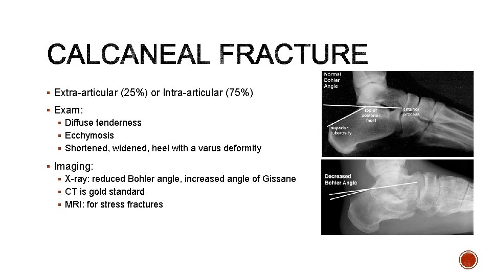 § Extra-articular (25%) or Intra-articular (75%) § Exam: § Diffuse tenderness § Ecchymosis §