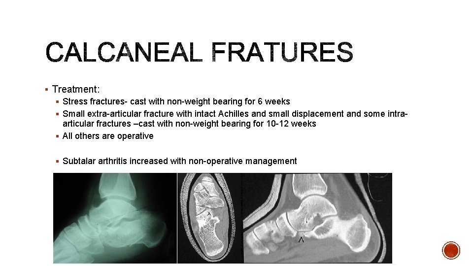 § Treatment: § Stress fractures- cast with non-weight bearing for 6 weeks § Small
