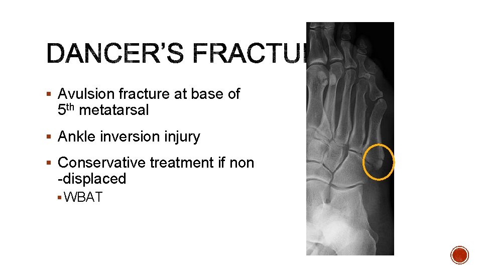 § Avulsion fracture at base of 5 th metatarsal § Ankle inversion injury §