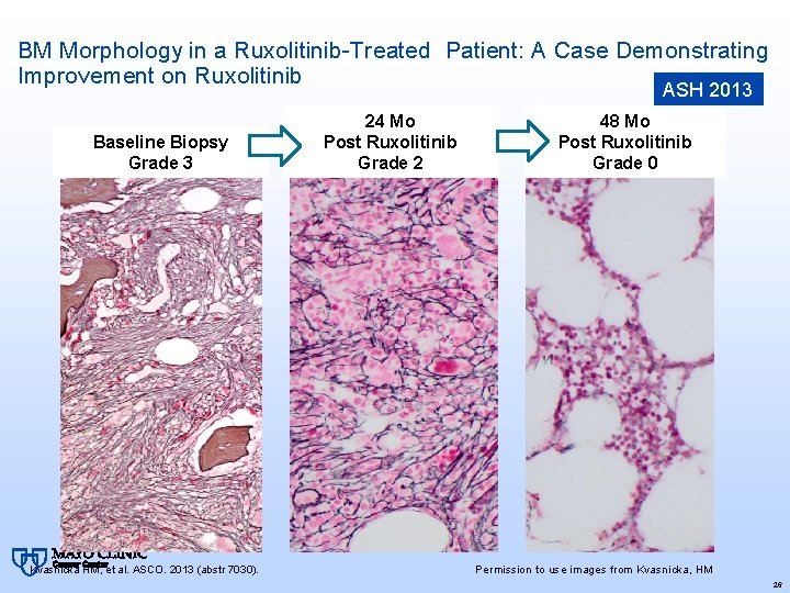 BM Morphology in a Ruxolitinib-Treated Patient: A Case Demonstrating Improvement on Ruxolitinib ASH 2013