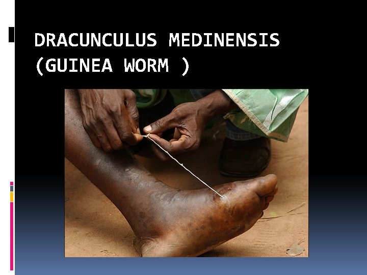 DRACUNCULUS MEDINENSIS (GUINEA WORM ) 
