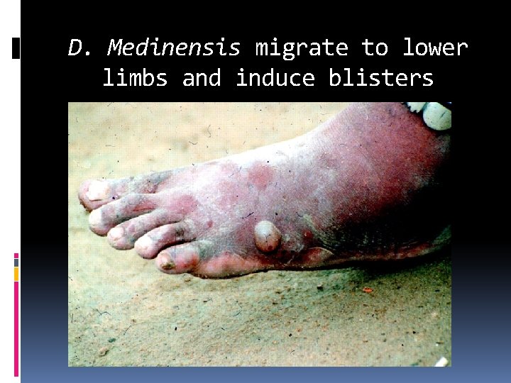 D. Medinensis migrate to lower limbs and induce blisters 