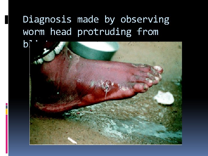 Diagnosis made by observing worm head protruding from blister 