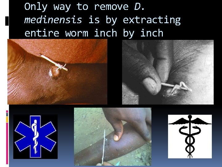 Only way to remove D. medinensis is by extracting entire worm inch by inch