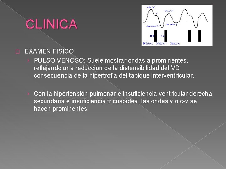 CLINICA � EXAMEN FISICO › PULSO VENOSO: Suele mostrar ondas a prominentes, reflejando una