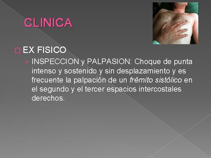 CLINICA � EX FISICO › INSPECCION y PALPASION: Choque de punta intenso y sostenido