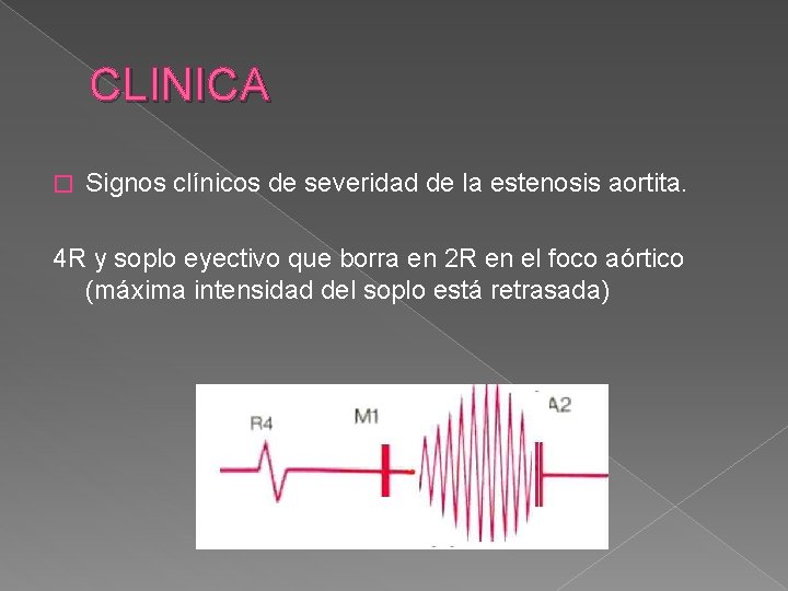 CLINICA � Signos clínicos de severidad de la estenosis aortita. 4 R y soplo