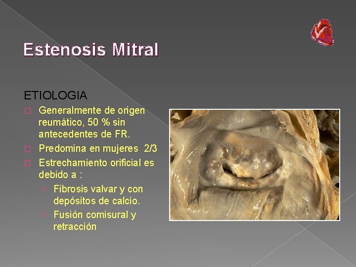 Estenosis Mitral ETIOLOGIA Generalmente de origen reumático, 50 % sin antecedentes de FR. �