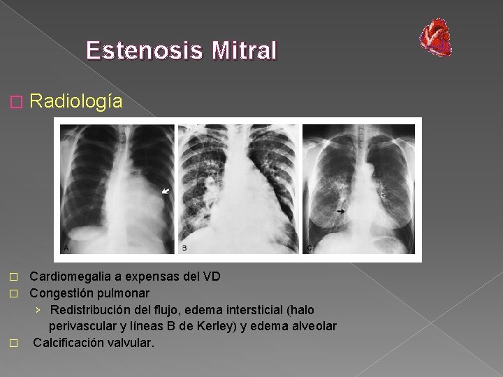 Estenosis Mitral � Radiología Cardiomegalia a expensas del VD � Congestión pulmonar › Redistribución