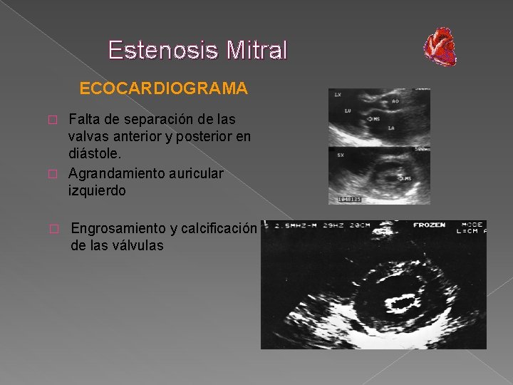 Estenosis Mitral ECOCARDIOGRAMA Falta de separación de las valvas anterior y posterior en diástole.