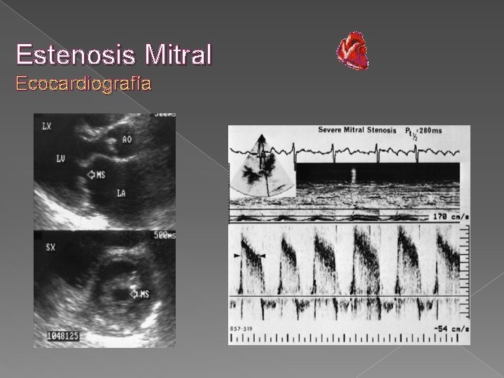 Estenosis Mitral Ecocardiografía 