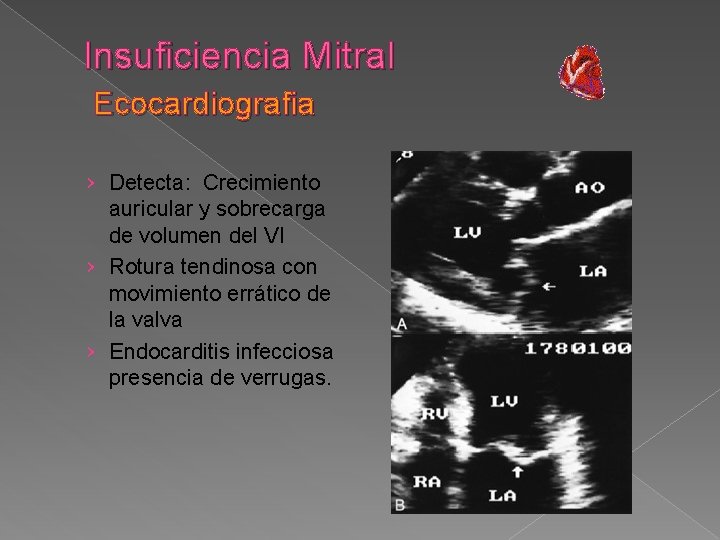 Insuficiencia Mitral Ecocardiografia › Detecta: Crecimiento auricular y sobrecarga de volumen del VI ›