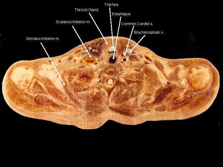 Trachea Thyroid Gland Scalenus Anterior m. Esophagus Common Carotid a. Brachiocephalic v. Serratus Anterior
