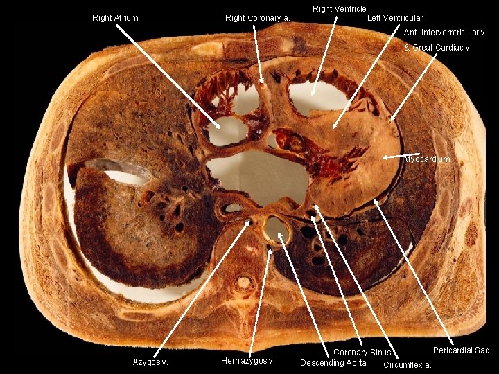 Right Atrium Right Coronary a. Right Ventricle Left Ventricular Ant. Interverntricular v. & Great