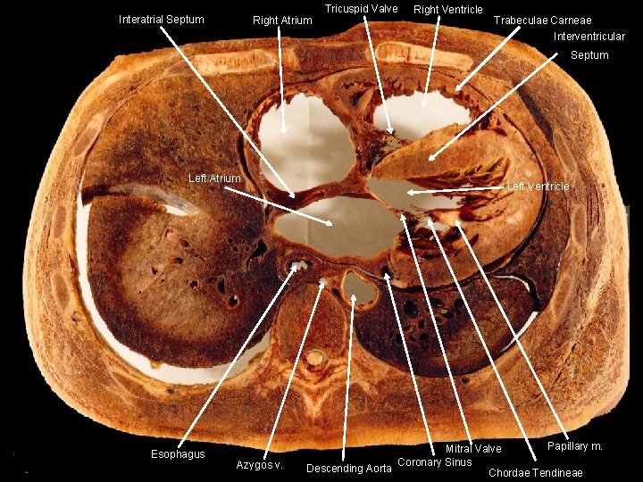 Interatrial Septum Right Atrium Tricuspid Valve Right Ventricle Trabeculae Carneae Interventricular Septum Left Atrium