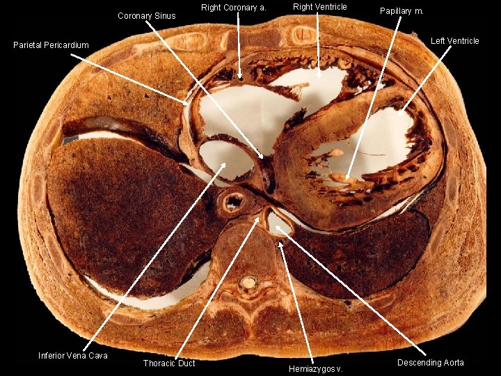 Coronary Sinus Right Coronary a. Right Ventricle Left Ventricle Parietal Pericardium Inferior Vena Cava
