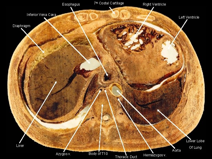 Esophagus 7 th Costal Cartilage Right Ventricle Inferior Vena Cava Left Ventricle Diaphragm Lower