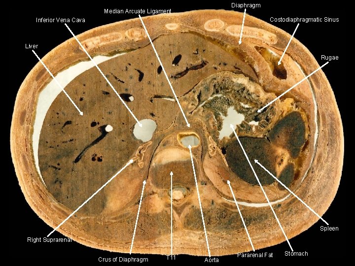 Diaphragm Median Arcuate Ligament Costodiaphragmatic Sinus Inferior Vena Cava Liver Rugae Spleen Right Suprarenal