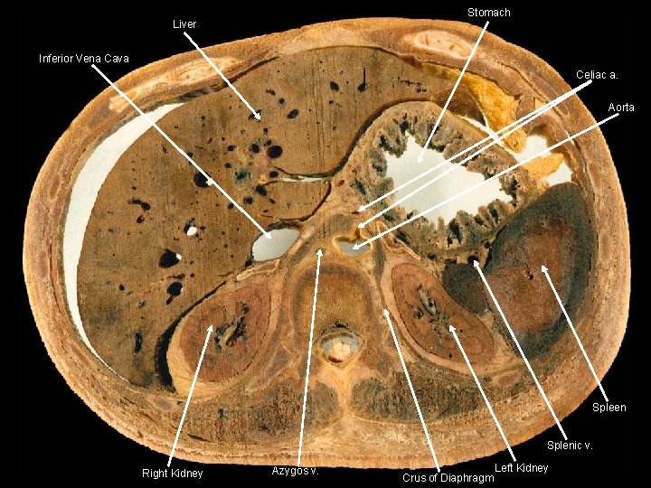 Stomach Liver Inferior Vena Cava Celiac a. Aorta Spleen Splenic v. Right Kidney Azygos