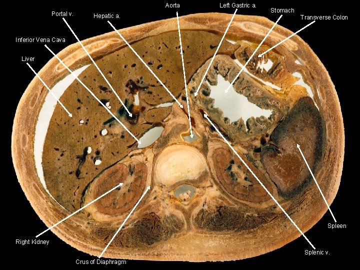 Aorta Portal v. Hepatic a. Left Gastric a. Stomach Transverse Colon Inferior Vena Cava