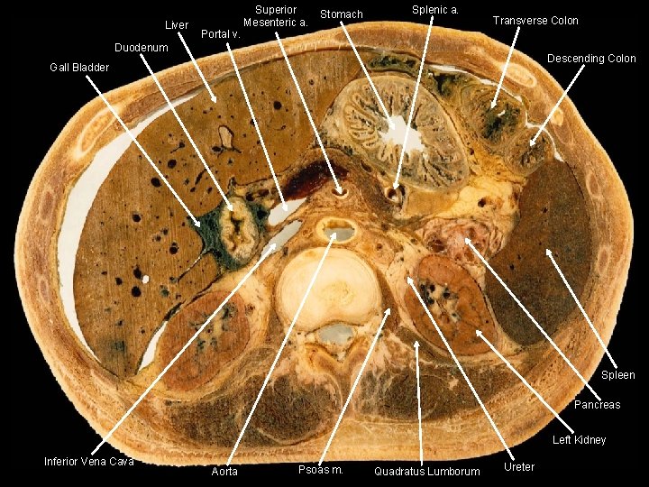 Liver Portal v. Superior Mesenteric a. Stomach Splenic a. Transverse Colon Duodenum Descending Colon