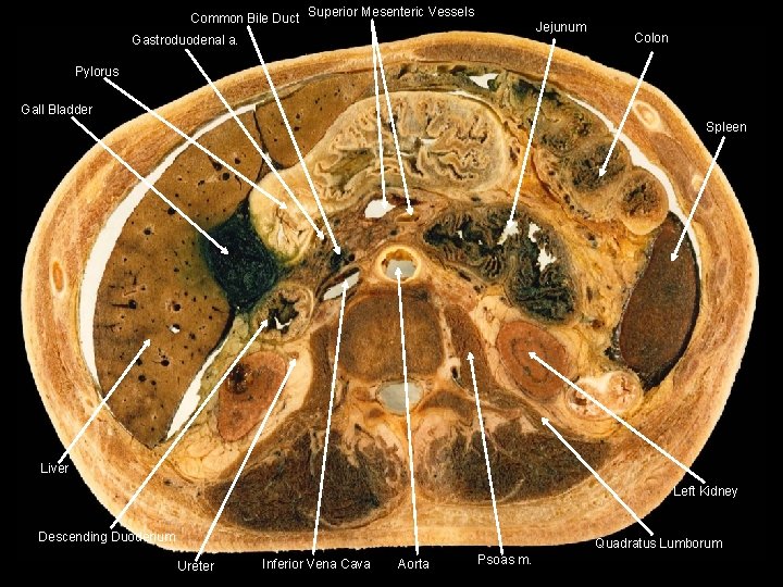Common Bile Duct Superior Mesenteric Vessels Jejunum Gastroduodenal a. Colon Pylorus Gall Bladder Spleen