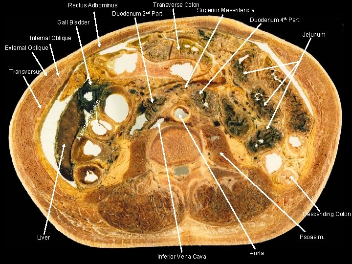 Transverse Colon Rectus Adbominus Superior Mesenteric a. Duodenum 2 nd Part Duodenum 4 th