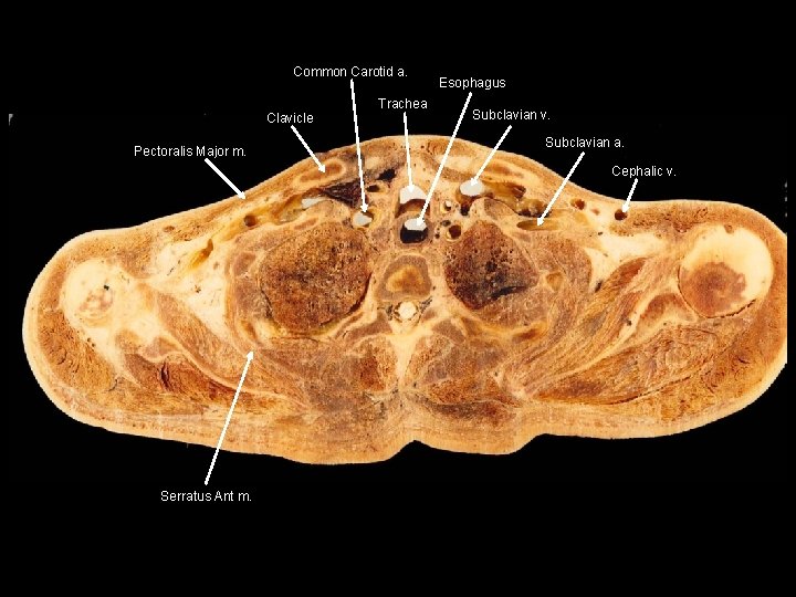 Common Carotid a. Clavicle Pectoralis Major m. Trachea Esophagus Subclavian v. Subclavian a. Cephalic
