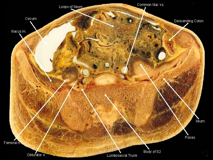 Loops of Ileum Common Iliac vs. Cecum Descending Colon Iliacus m. Ileum Psoas Femoral
