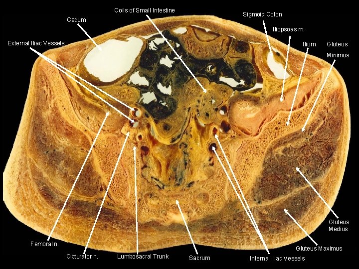 Coils of Small Intestine Sigmoid Colon Cecum Iliopsoas m. External Iliac Vessels Ilium Gluteus