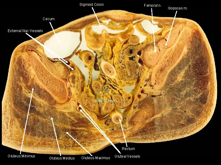 Sigmoid Colon Femoral n. Cecum External Iliac Vessels Loops of Ileum Rectum Gluteus Minimus