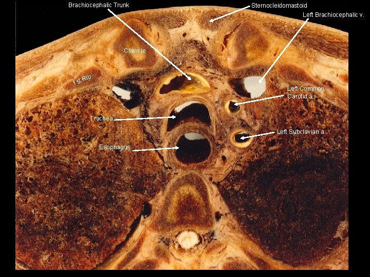 Brachiocephalic Trunk Sternocleidomastoid Left Brachiocephalic v. Clavicle 1 st Rib Left Common Carotid a.