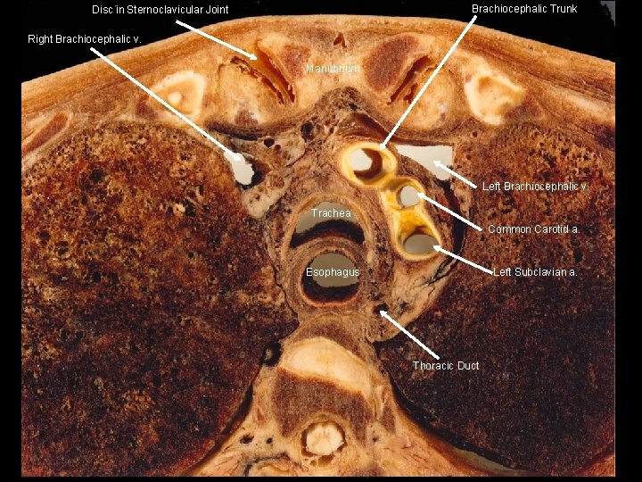 Brachiocephalic Trunk Disc in Sternoclavicular Joint Right Brachiocephalic v. Manubrium Left Brachiocephalic v. Trachea