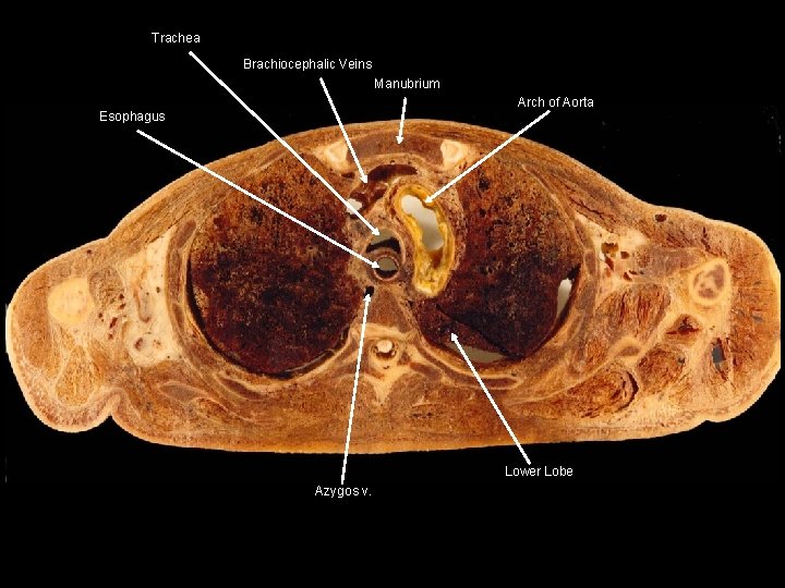 Trachea Brachiocephalic Veins Manubrium Arch of Aorta Esophagus Lower Lobe Azygos v. 