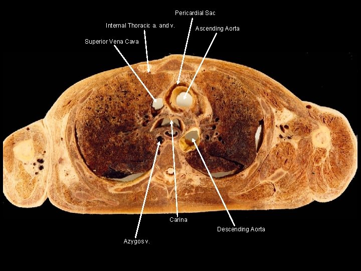 Pericardial Sac Internal Thoracic a. and v. Ascending Aorta Superior Vena Cava Carina Descending