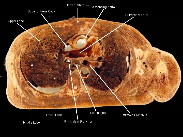 Body of Sternum Ascending Aorta Superior Vena Cava Pulmonary Trunk Upper Lobe Lower Lobe