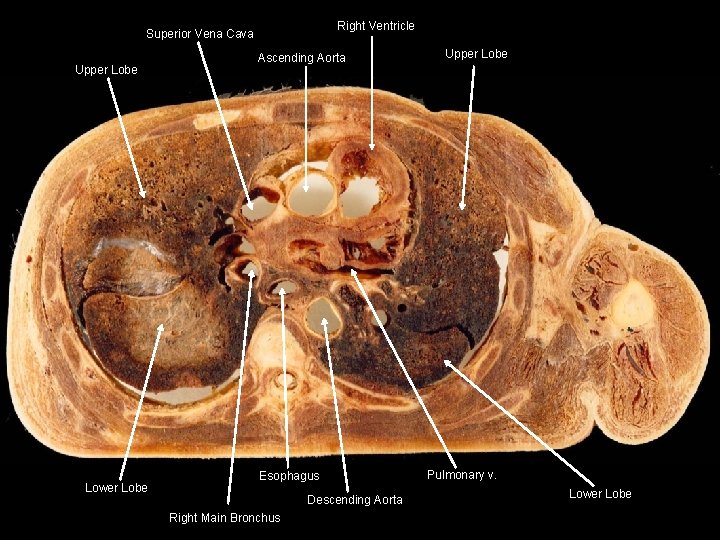Right Ventricle Superior Vena Cava Upper Lobe Lower Lobe Ascending Aorta Esophagus Descending Aorta
