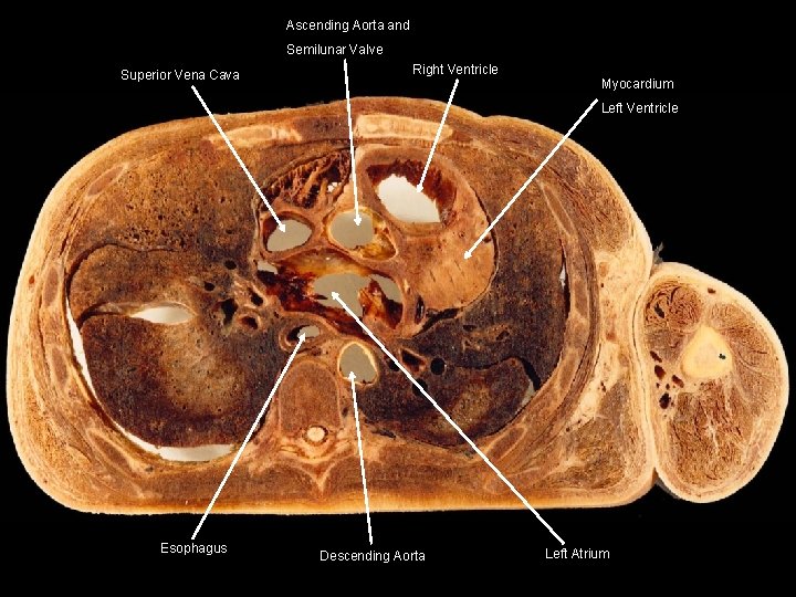 Ascending Aorta and Semilunar Valve Superior Vena Cava Right Ventricle Myocardium Left Ventricle Esophagus