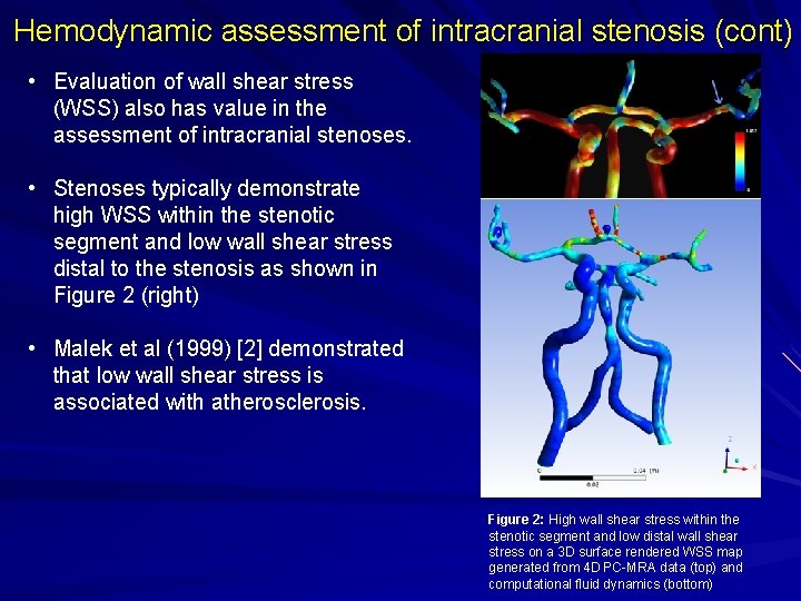 Hemodynamic assessment of intracranial stenosis (cont) • Evaluation of wall shear stress (WSS) also