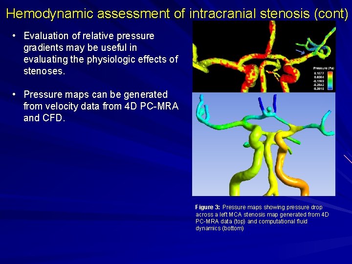 Hemodynamic assessment of intracranial stenosis (cont) • Evaluation of relative pressure gradients may be