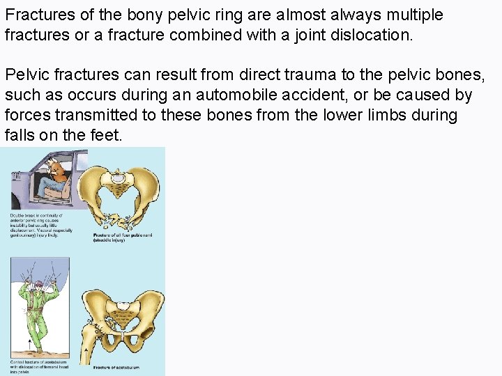 Fractures of the bony pelvic ring are almost always multiple fractures or a fracture