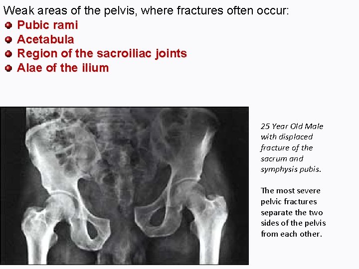 Weak areas of the pelvis, where fractures often occur: Pubic rami Acetabula Region of