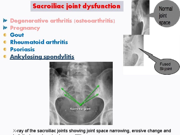 Sacroiliac joint dysfunction Degenerative arthritis (osteoarthritis) Pregnancy Gout Rheumatoid arthritis Psoriasis Ankylosing spondylitis X-ray