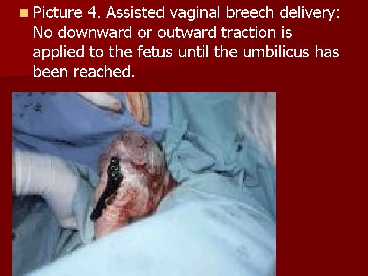 n Picture 4. Assisted vaginal breech delivery: No downward or outward traction is applied