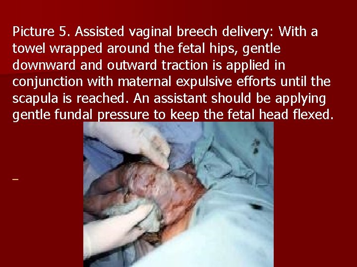 Picture 5. Assisted vaginal breech delivery: With a towel wrapped around the fetal hips,